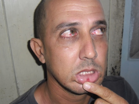 Jorge Vázquez muestra las lesiones por golpiza del oficial de la seguridad del estado Erick Francis Aquino Abreu en Sta Clara